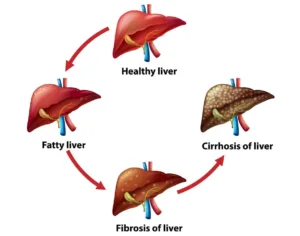 Chronic Liver Disease